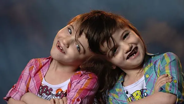 10 удивительных историй самых известных сиамских близнецов (16 фото)