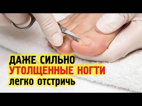 СЕКРЕТ ? как постричь толстые и жесткие ногти на ногах. Узнайте как размягчить ногти сделать тонкими